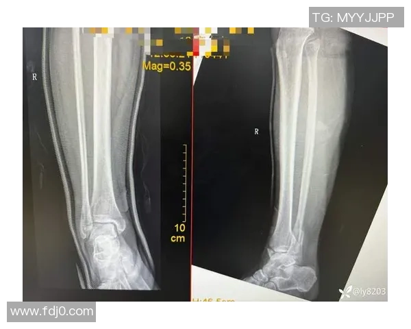 踝关节骨折影响职业生涯的足球明星们的奋斗与复苏故事 踝关节骨折影响职业生涯的足球明星们的奋斗与复苏故事